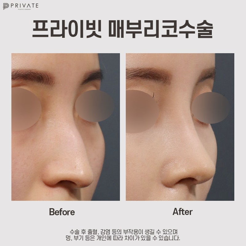 매부리코성형후기가 좋은 신사 프라이빗성형외과 사진 8