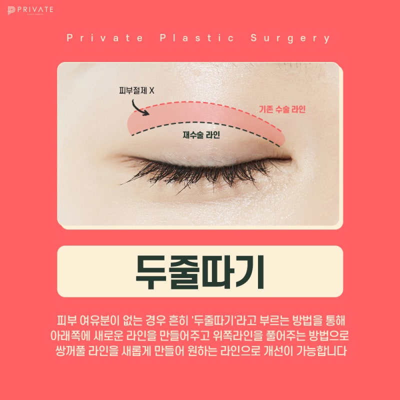 Eye Reoperation Specialist: Sinsa Private Plastic Surgery Clinic 사진 5
