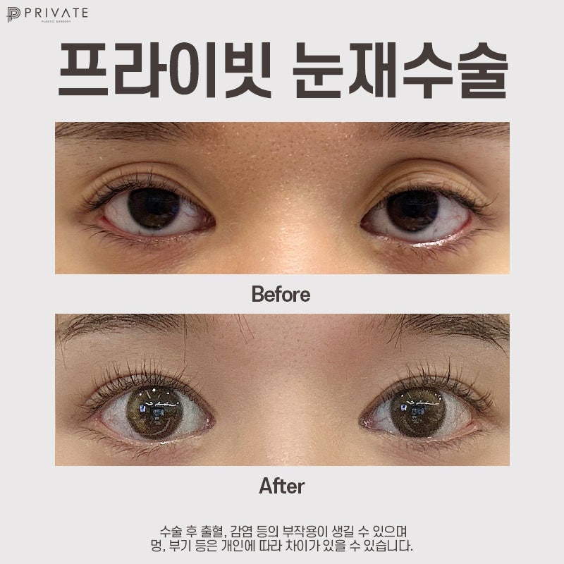 Eye Reoperation Specialist: Sinsa Private Plastic Surgery Clinic 사진 9