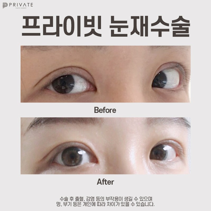 Eye Reoperation Specialist: Sinsa Private Plastic Surgery Clinic 사진 8