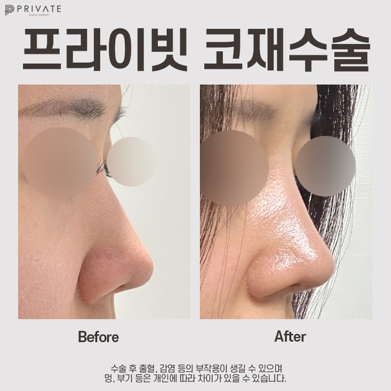 Sinsa Private Plastic Surgery Clinic for Nose Revision Surgery 사진 10