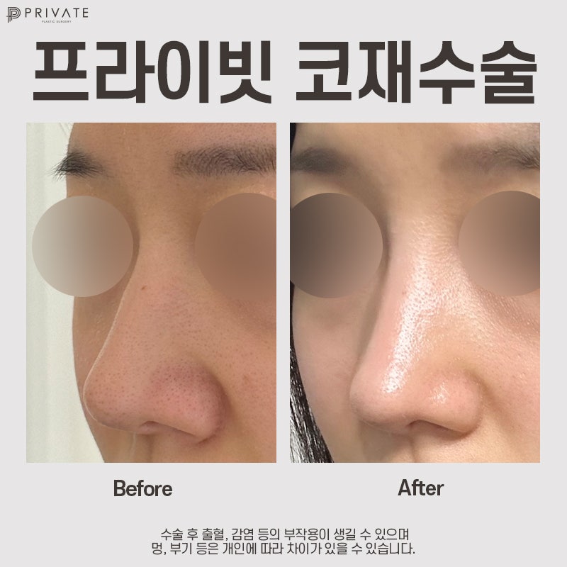 Sinsa Private Plastic Surgery Clinic for Nose Revision Surgery 사진 9