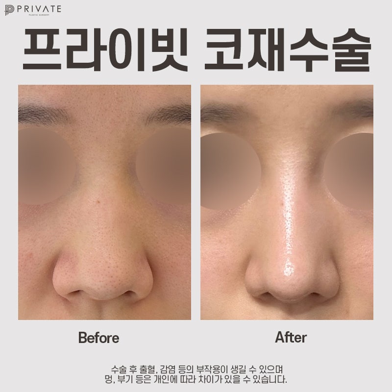 Sinsa Private Plastic Surgery Clinic for Nose Revision Surgery 사진 8
