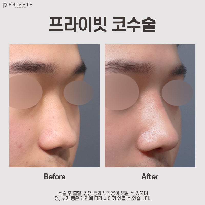 남자코성형전후 후기가 좋은 프라이빗성형외과 사진 11