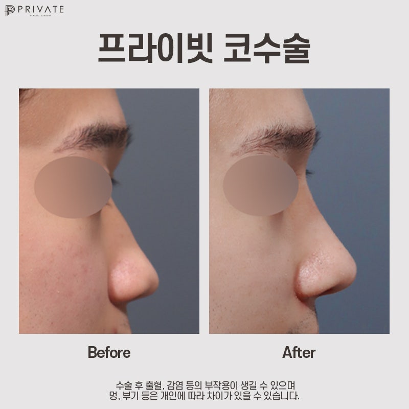 남자코성형전후 후기가 좋은 프라이빗성형외과 사진 10