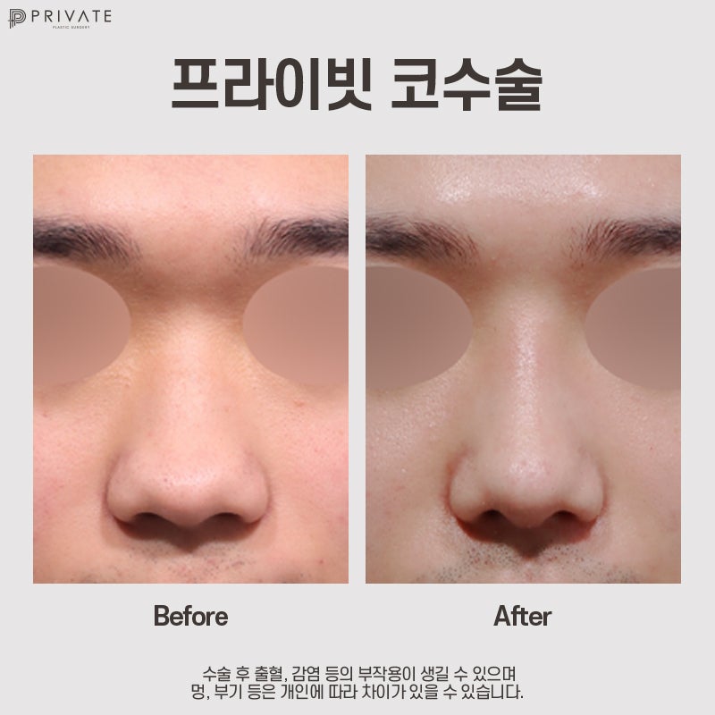 남자코성형전후 후기가 좋은 프라이빗성형외과 사진 9