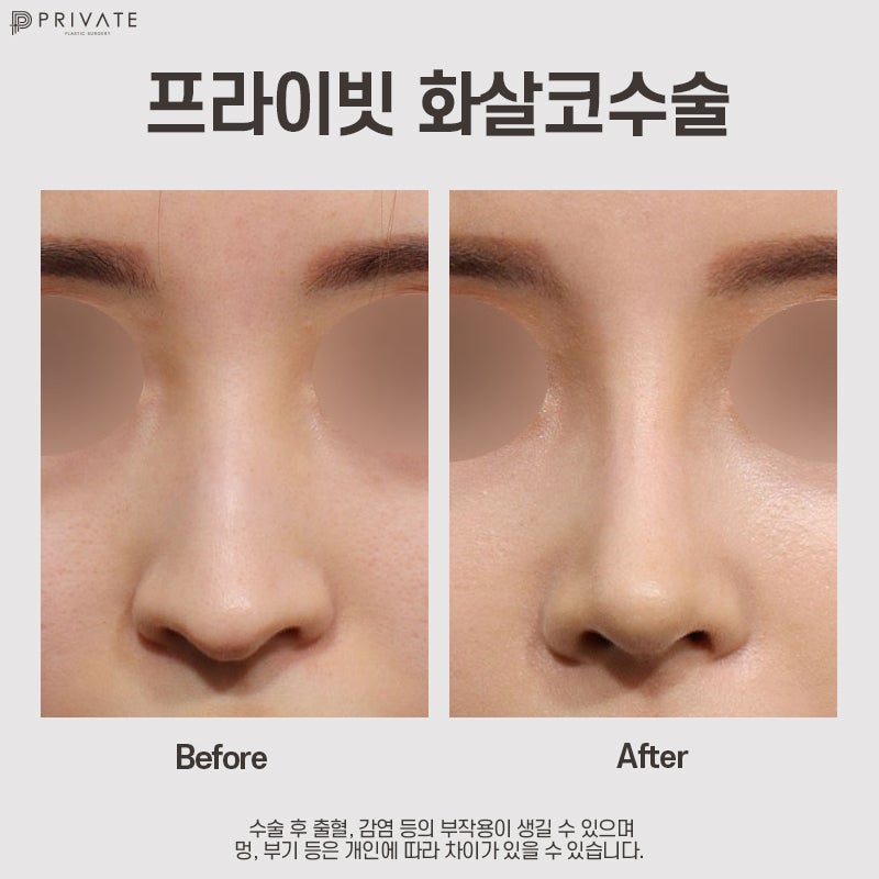 Arrow-Tip Nose Correction Surgery: Learn More at Private Plastic Surgery Clinic 사진 7