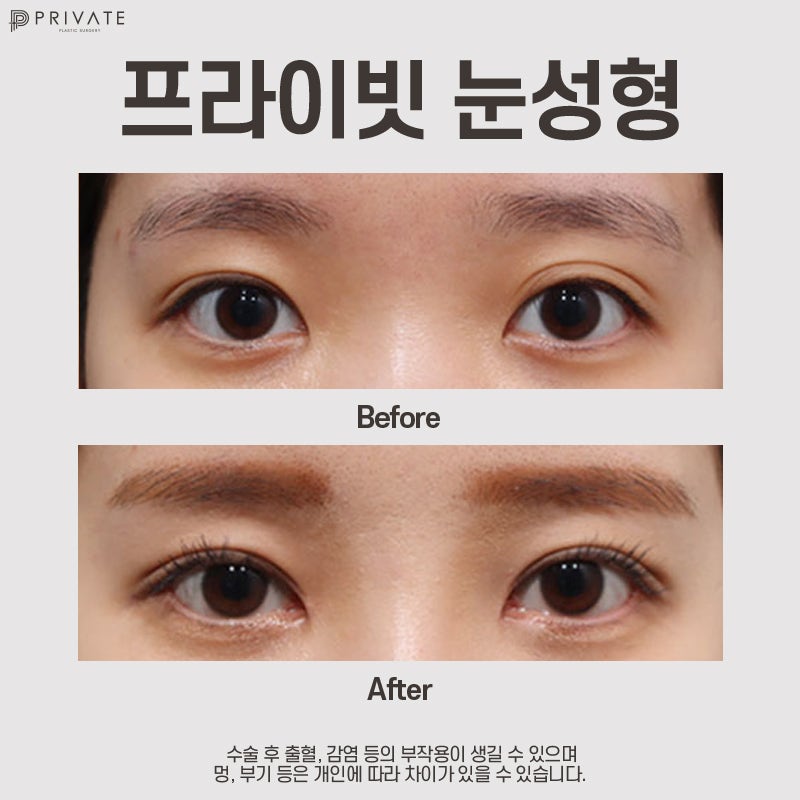 Sinsa Private Plastic Surgery: Excellent Before-and-After Double Eyelid Surgery Results 사진 8