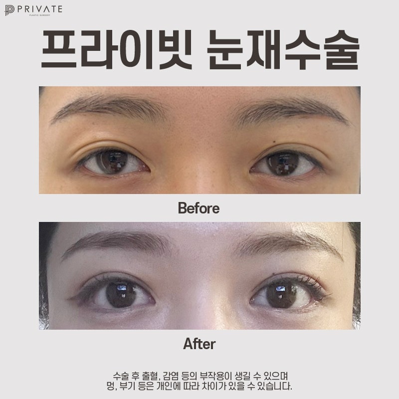 Eye Revision Surgery at Sinsa Private Plastic Surgery Clinic 사진 8