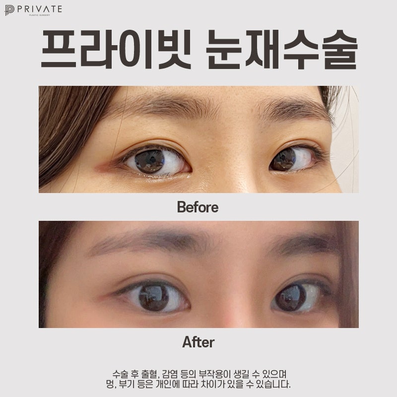 Eye Revision Surgery at Sinsa Private Plastic Surgery Clinic 사진 9