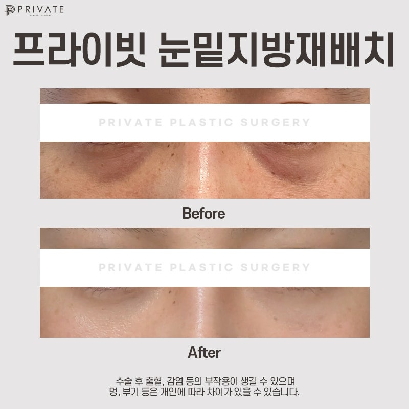 โรงพยาบาลที่เก่งเรื่องการจัดเรียงไขมันใต้ตาคือ Private Plastic Surgery สาขาชินซา 사진 8
