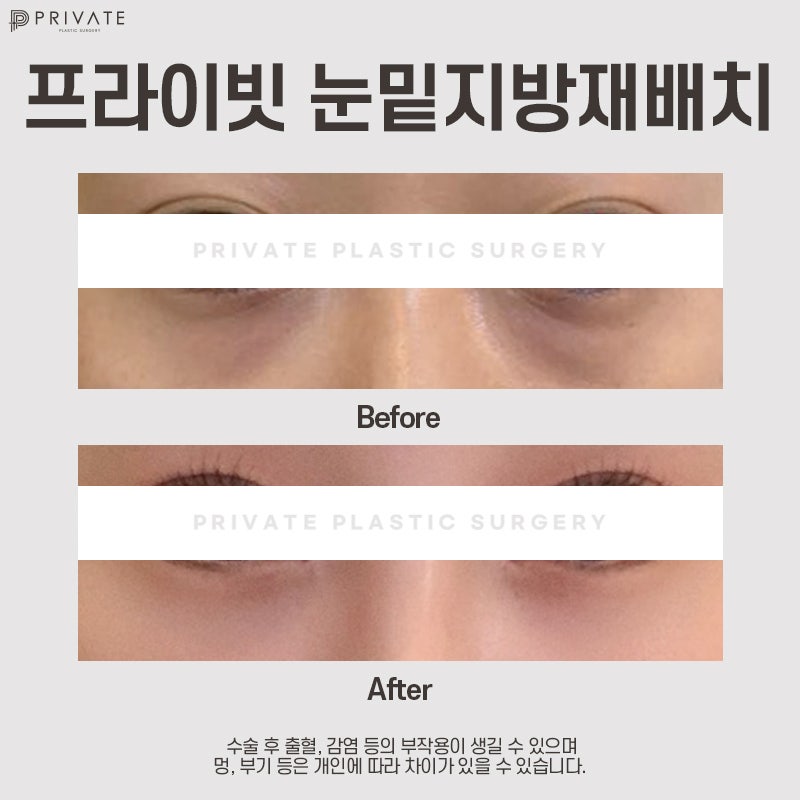 โรงพยาบาลที่เก่งเรื่องการจัดเรียงไขมันใต้ตาคือ Private Plastic Surgery สาขาชินซา 사진 7