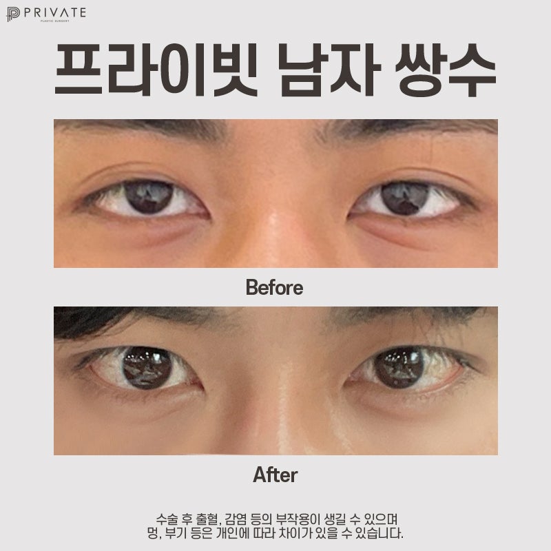 Klinik Bedah Mata Pria Terbaik di Sinsa Private Plastic Surgery 사진 8