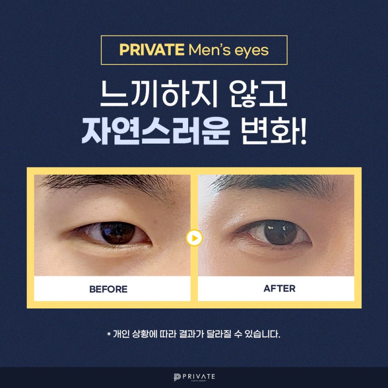 Klinik Bedah Mata Pria Terbaik di Sinsa Private Plastic Surgery 사진 5
