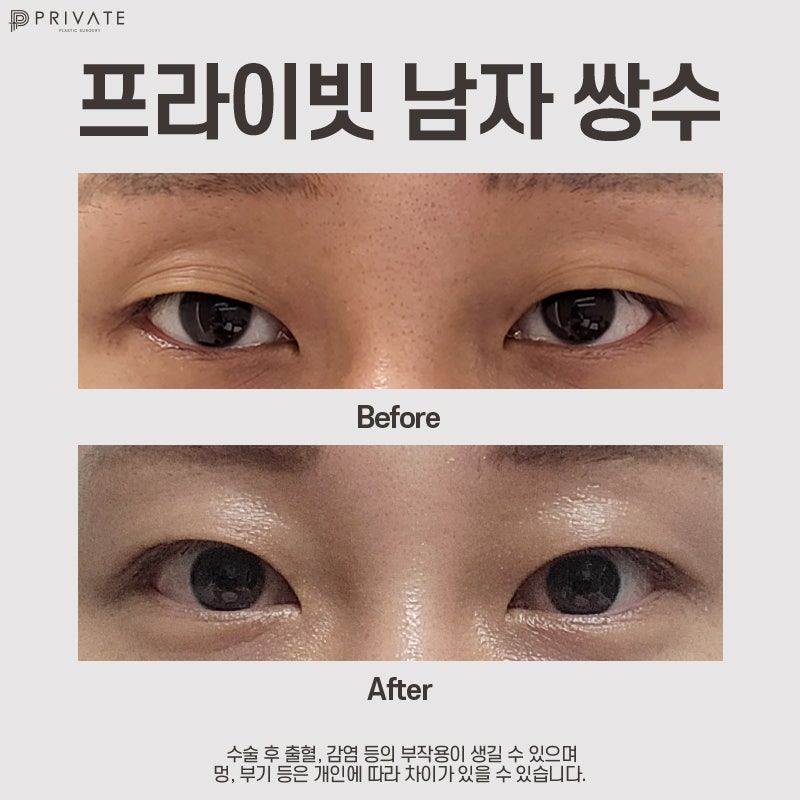 Klinik Bedah Mata Pria Terbaik di Sinsa Private Plastic Surgery 사진 9
