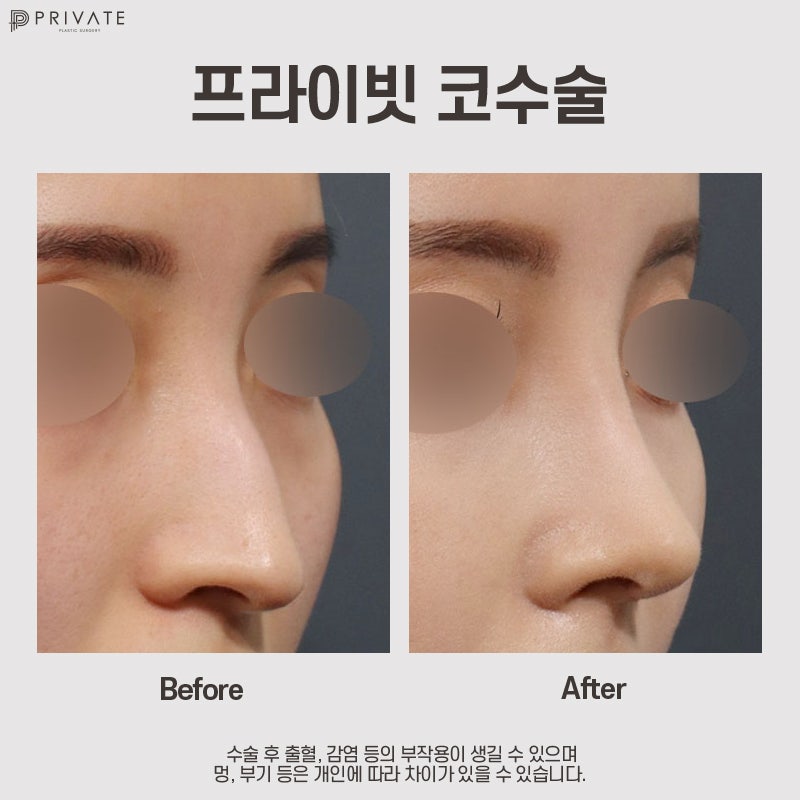 매부리코수술후기 좋은곳 프라이빗성형외과 사진 8