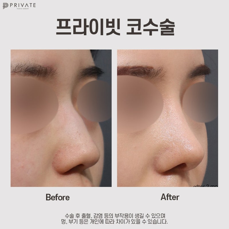 매부리코수술후기 좋은곳 프라이빗성형외과 사진 10