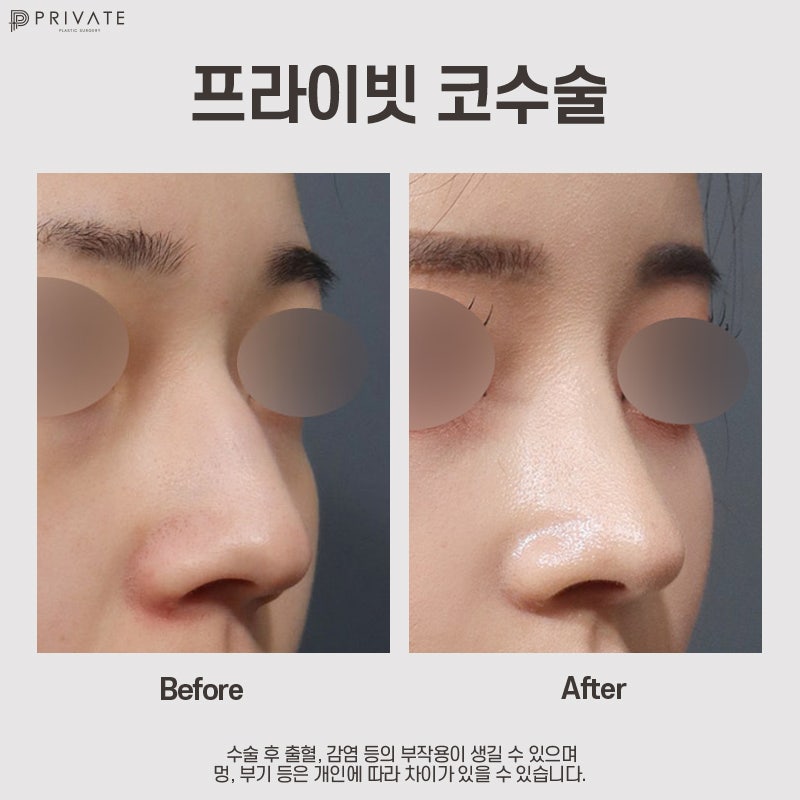 매부리코수술후기 좋은곳 프라이빗성형외과 사진 9