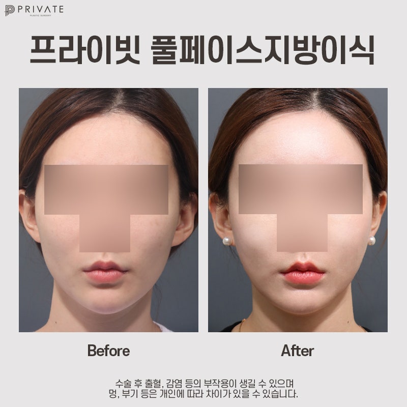 Private Plastic Surgery Clinic PRP Full Face Fat Grafting 사진 10