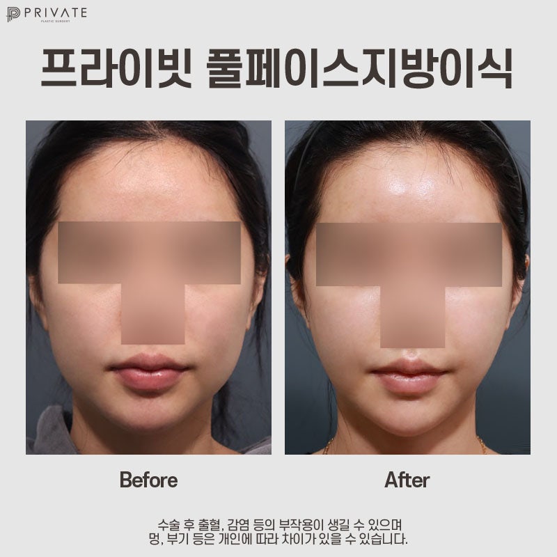 Private Plastic Surgery Clinic PRP Full Face Fat Grafting 사진 8