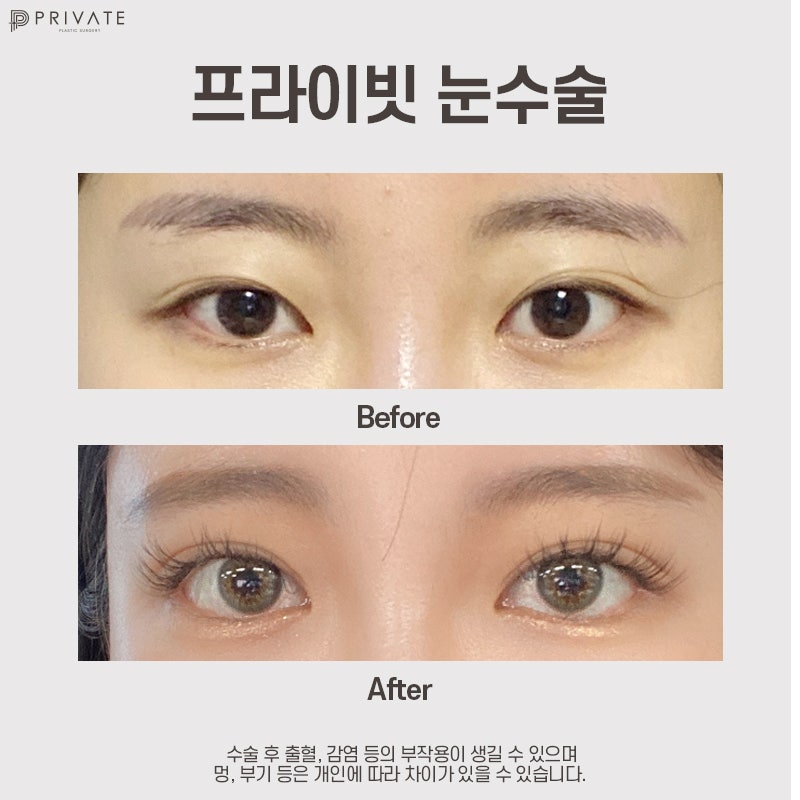 First Eye Surgery at Sinsa Station Private Plastic Surgery Clinic 사진 9