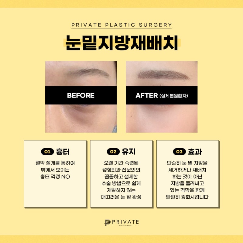 รีวิวดีๆ หลังทำศัลยกรรมใต้ตา ที่ Private Plastic Surgery คลินิกศัลยกรรมชินซา 사진 5