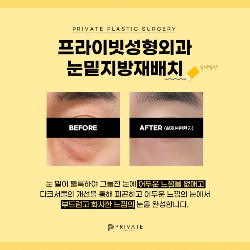 รีวิวดีๆ หลังทำศัลยกรรมใต้ตา ที่ Private Plastic Surgery คลินิกศัลยกรรมชินซา