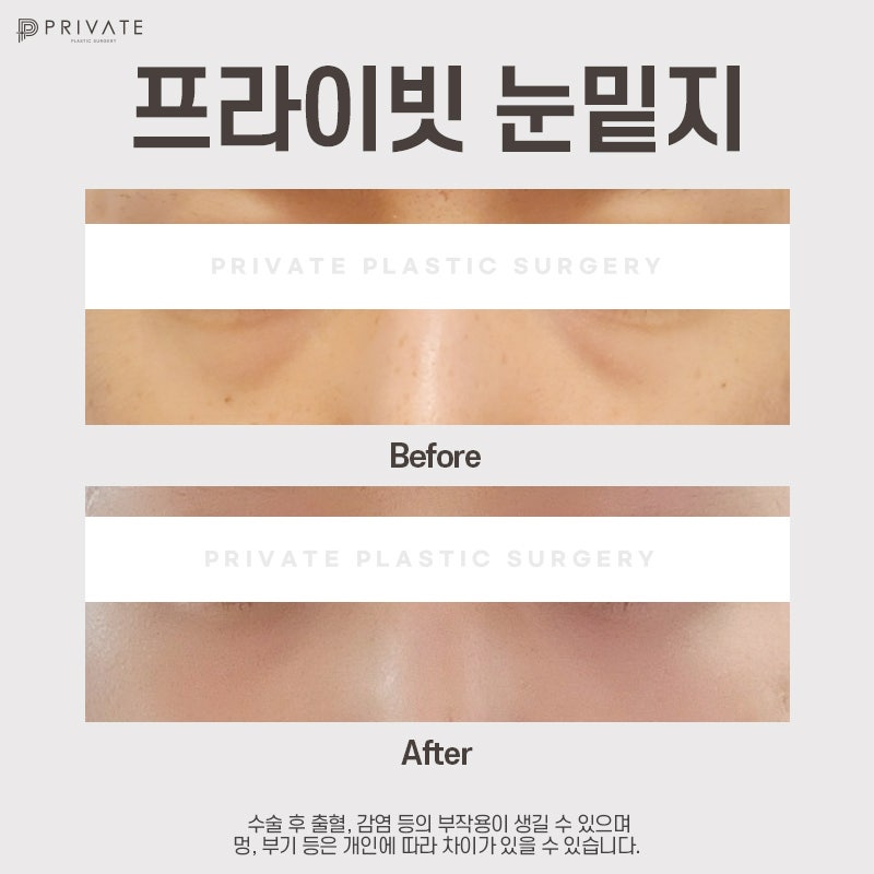 รีวิวดีๆ หลังทำศัลยกรรมใต้ตา ที่ Private Plastic Surgery คลินิกศัลยกรรมชินซา 사진 8