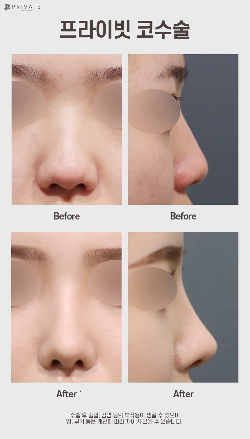 Ulasan Bagus Operasi Hidung Babi di Private Plastic Surgery Sinsa 사진 9