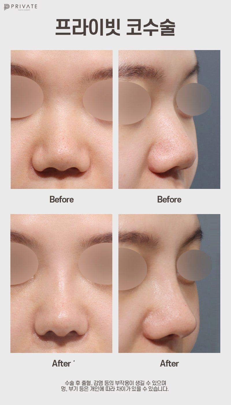Ulasan Bagus Operasi Hidung Babi di Private Plastic Surgery Sinsa 사진 8