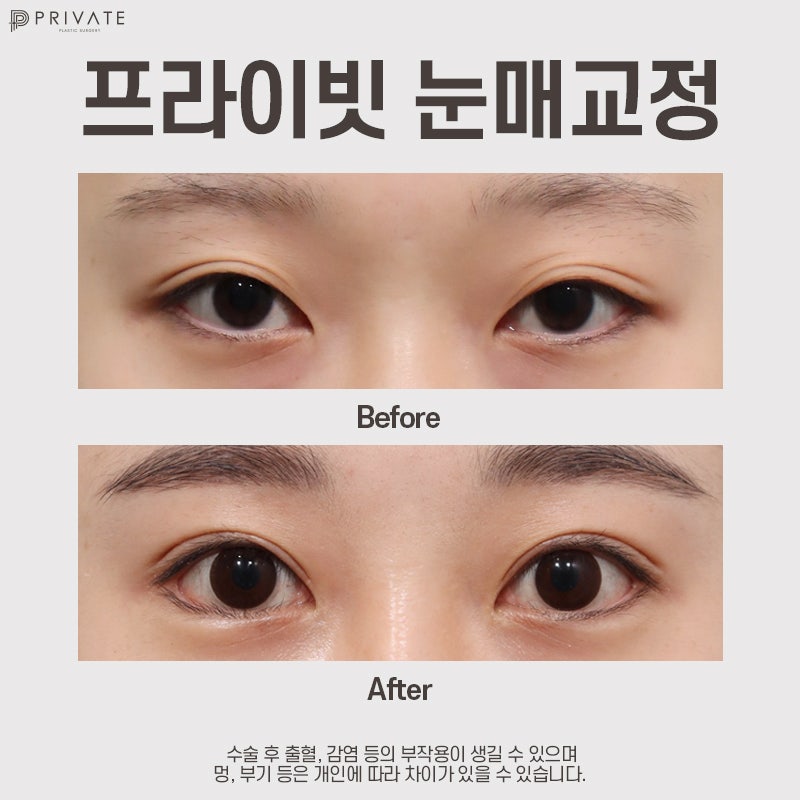 Ptosis Correction Surgery at Private Plastic Surgery Clinic 사진 7