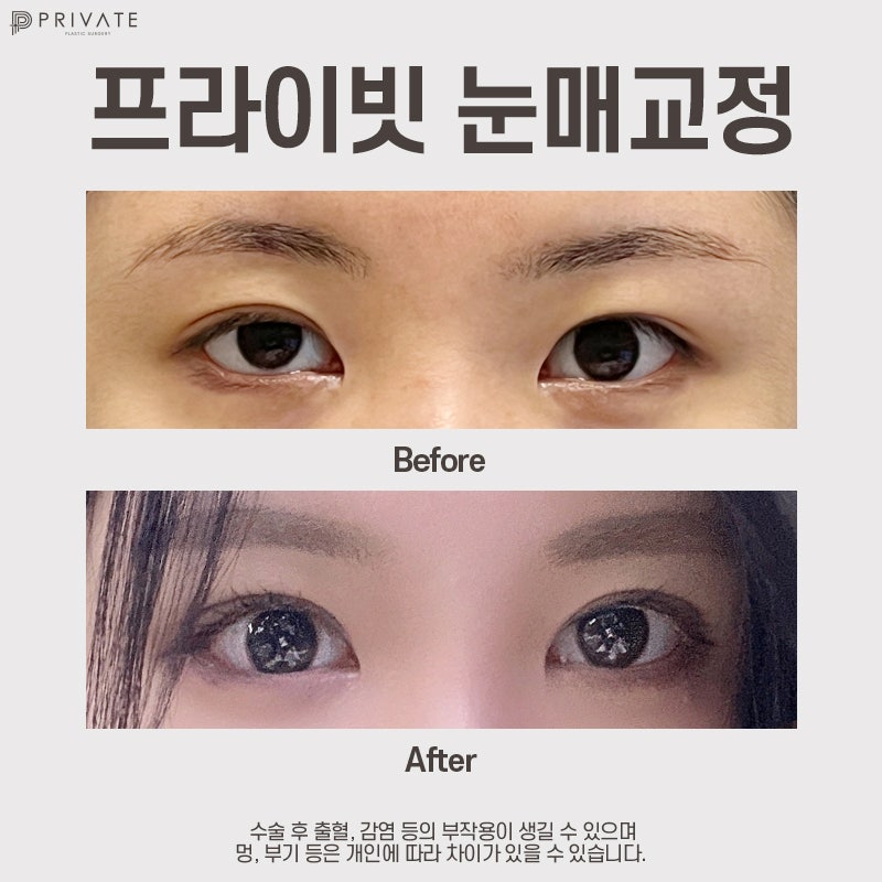 Ptosis Correction Surgery at Private Plastic Surgery Clinic 사진 8