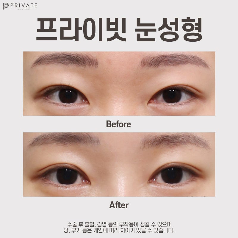 Sinsa Private Plastic Surgery: A Great Place for Double Eyelid Surgery 사진 9