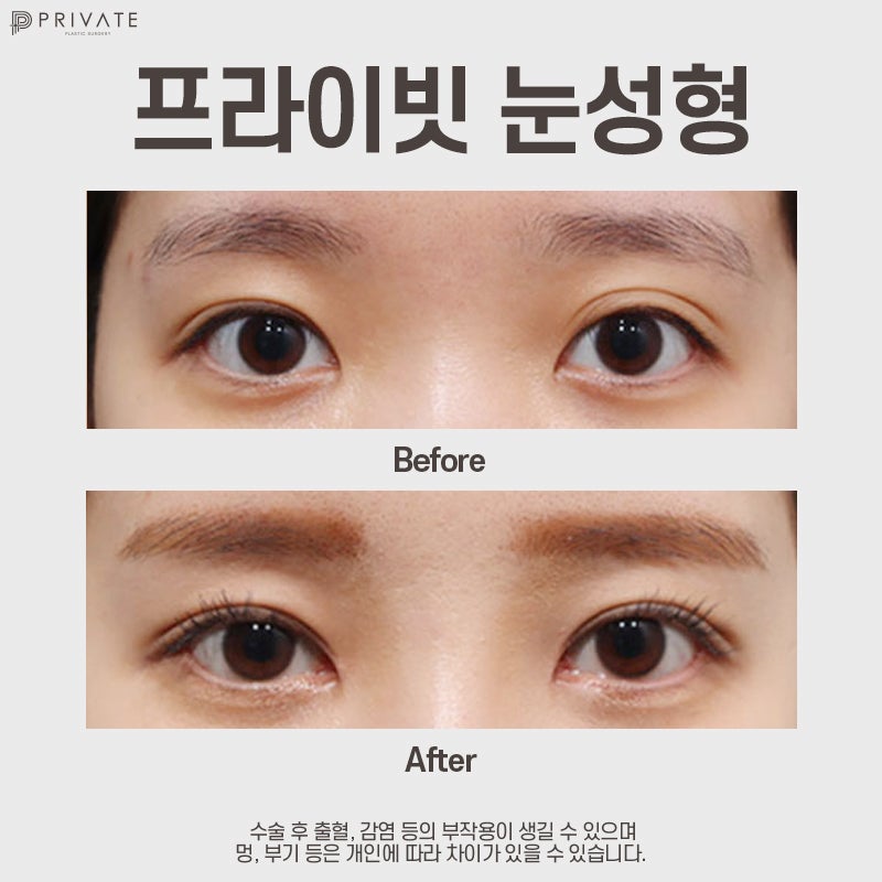 Sinsa Private Plastic Surgery: A Great Place for Double Eyelid Surgery 사진 8