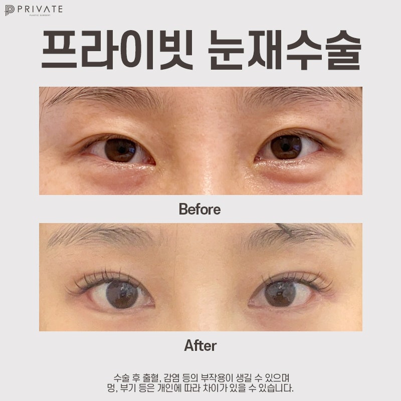 รีวิวศัลยกรรมตาแก้ที่ Private Plastic Surgery Clinic ในชินซา ที่มีรีวิวดี 사진 7