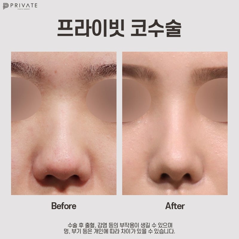복코성형전후 볼 수 있는 신사 프라이빗성형외과 사진 7