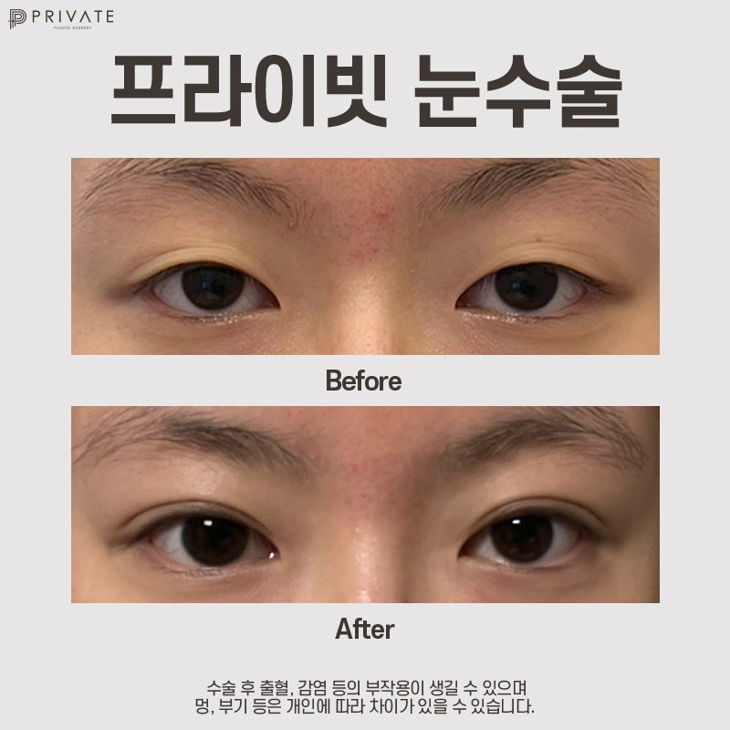 รีวิวศัลยกรรมแก้ไขตาสองชั้นแบบธรรมชาติที่ดีที่สุดที่ Private Plastic Surgery 사진 10