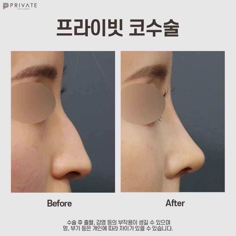 Klinik Bedah Plastik Hidung Elang, Private Plastic Surgery di Sinsa 사진 8