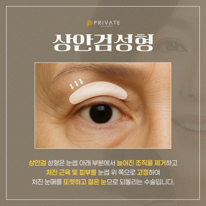 Upper Blepharoplasty at Sinsa Station Private Plastic Surgery Clinic