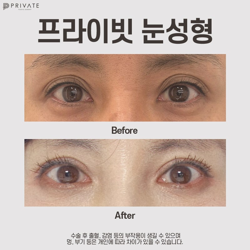 Upper Blepharoplasty at Sinsa Station Private Plastic Surgery Clinic 사진 7