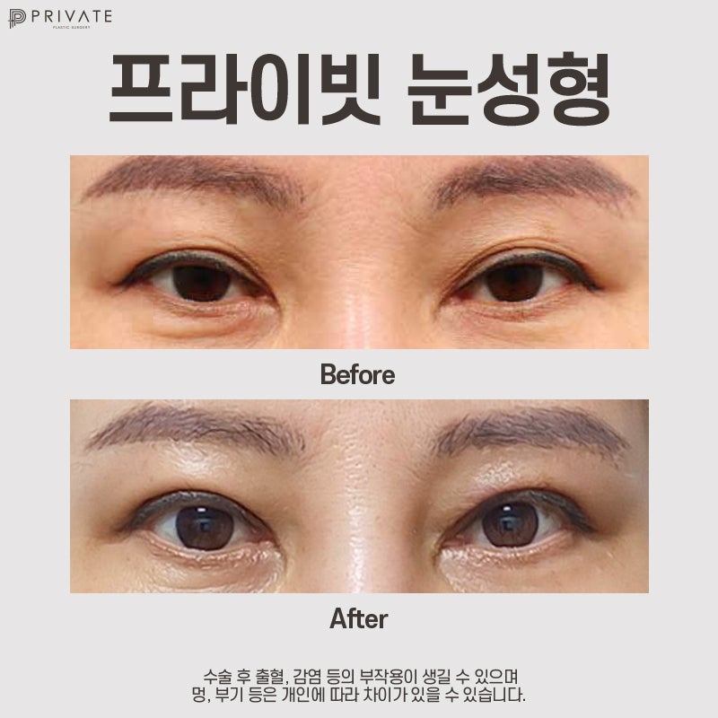 Upper Blepharoplasty at Sinsa Station Private Plastic Surgery Clinic 사진 8