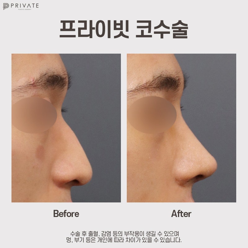 Jika Anda penasaran dengan ulasan operasi hidung pria, Private Plastic Surgery 사진 8