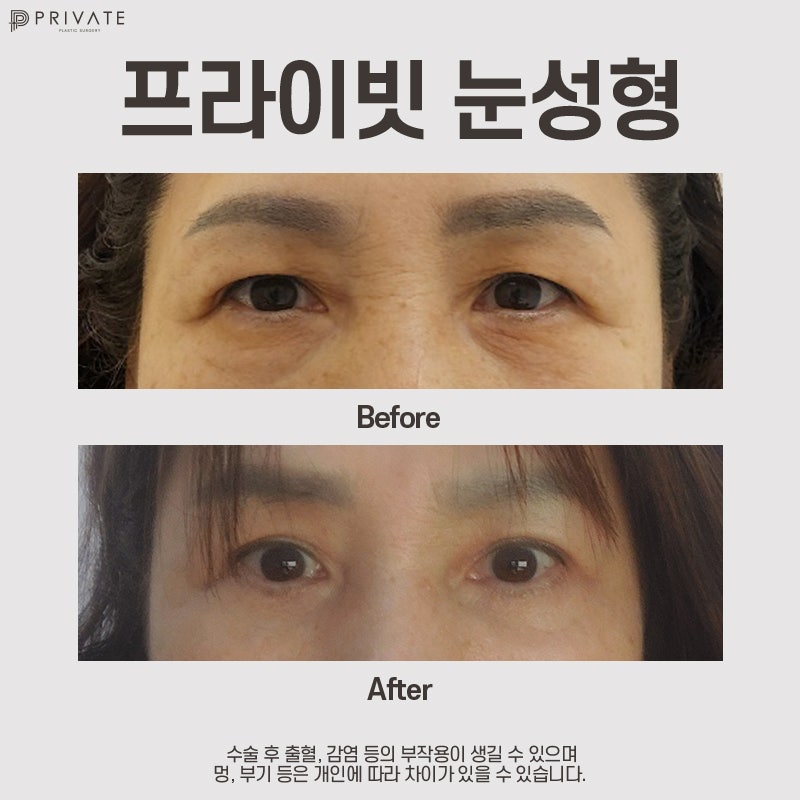 Sinsa Private Plastic Surgery Clinic: Lower Blepharoplasty Reviews 사진 7
