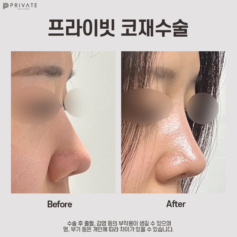 Ulasan Rumah Sakit Bedah Revisi Hidung, Cek di Private 사진 9