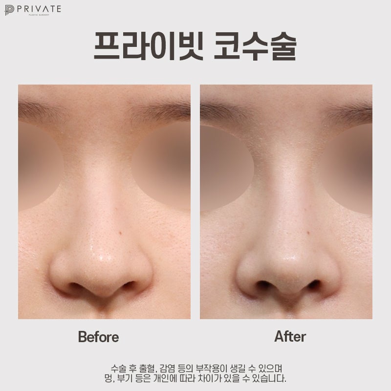 Sinsa Private Plastic Surgery Clinic: Excellent Reviews for Crooked Nose Surgery 사진 8