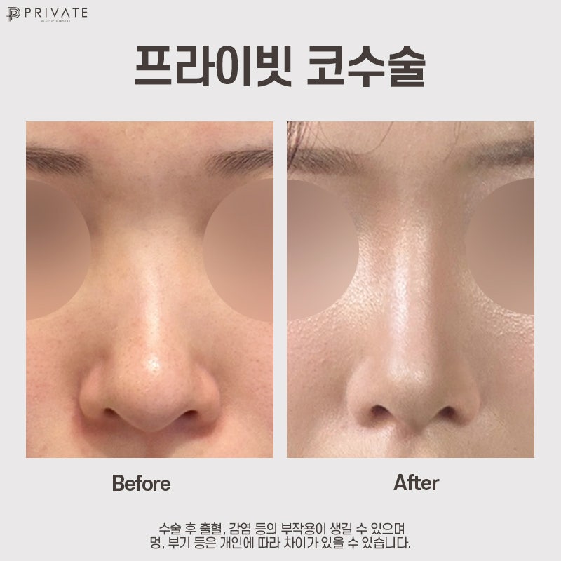 Sinsa Private Plastic Surgery Clinic: Excellent Reviews for Crooked Nose Surgery 사진 7