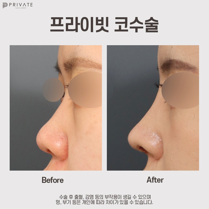 Sinsa Private Plastic Surgery: A Hospital Specializing in Nose Surgery 사진 8