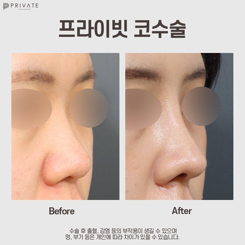 Sinsa Private Plastic Surgery: A Hospital Specializing in Nose Surgery 사진 9