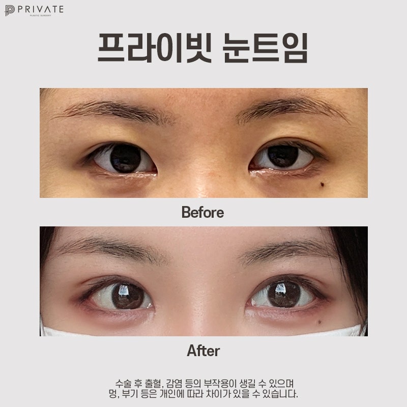 Private Plastic Surgery Clinic Excels in Canthoplasty 사진 8