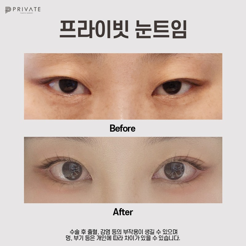 Private Plastic Surgery Clinic Excels in Canthoplasty 사진 7